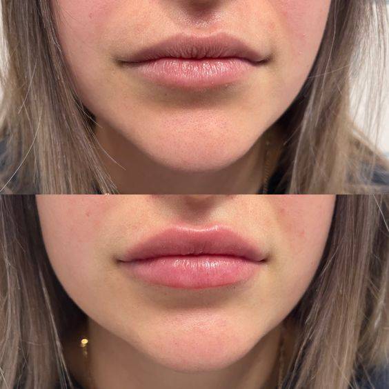 lip filler healing stages