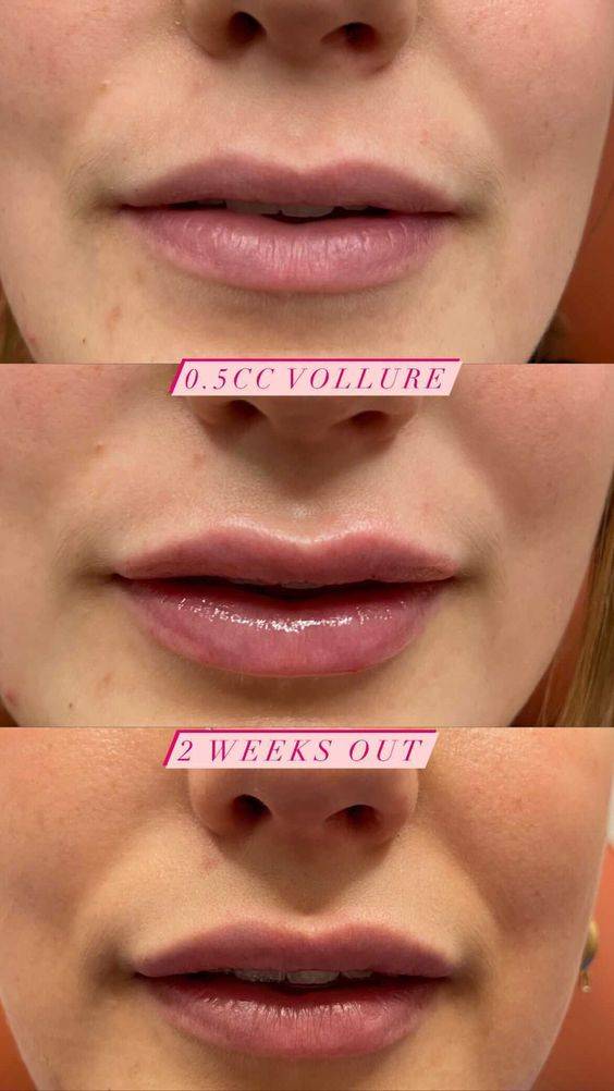 lip filler healing stages