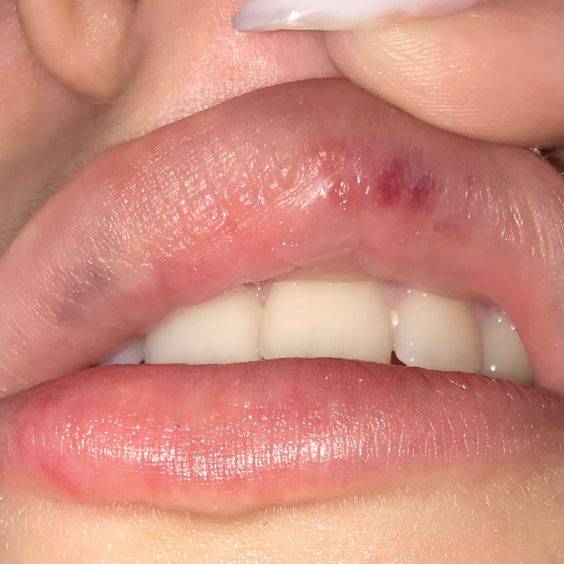 lip filler infection