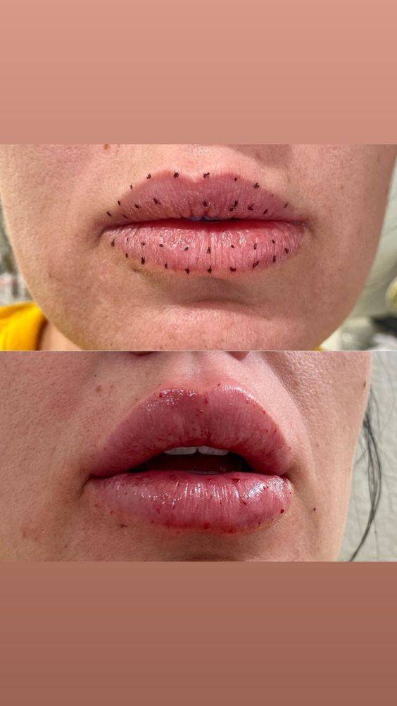 lip injection healing process