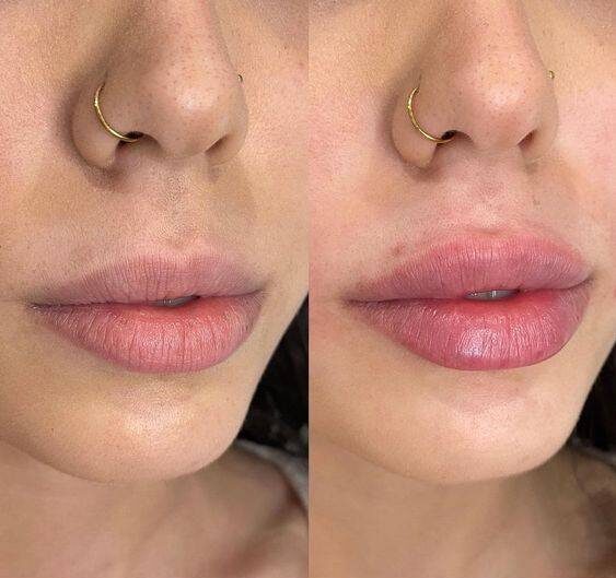 lip injections gone wrong