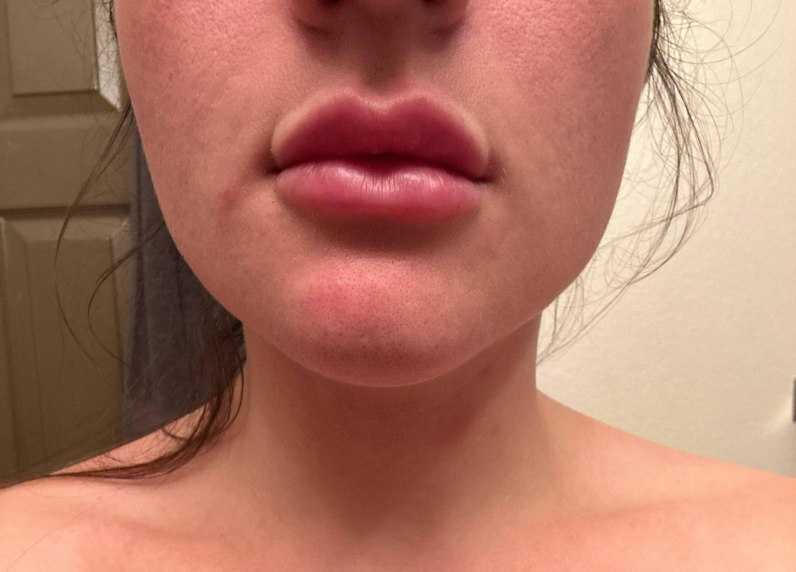 lip injections gone wrong