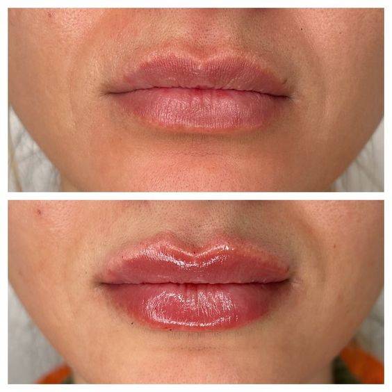 lips peeling after filler