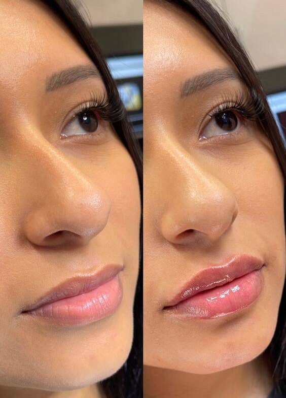 long-term side effects of lip fillers