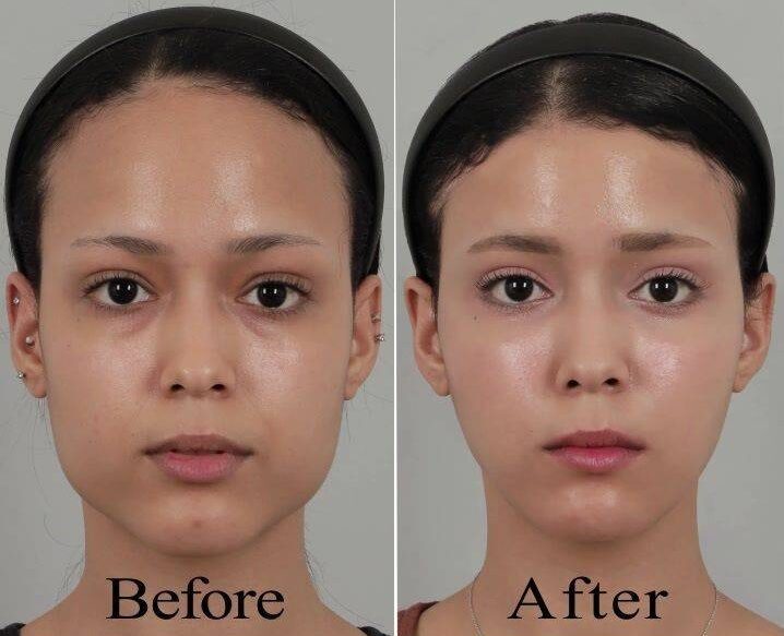 masseter botox before and after