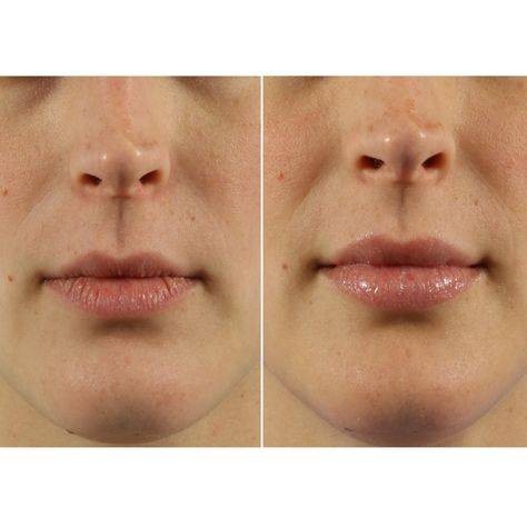 restylane lip lines treatment