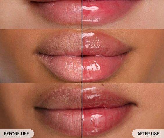 restylane lip lines treatment