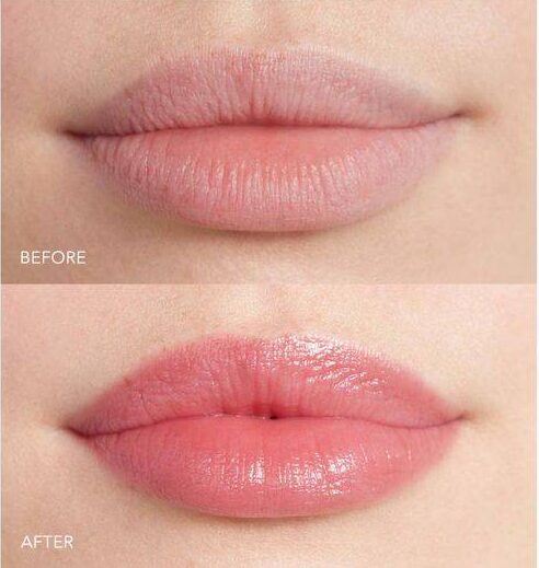 restylane lip lines treatment