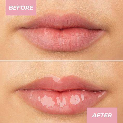 restylane lip lines treatment