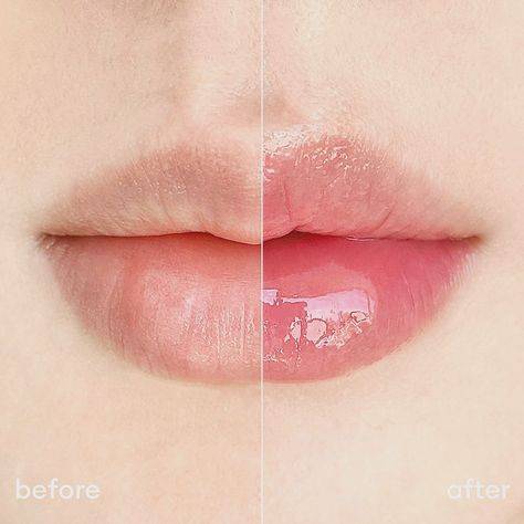 restylane lip lines treatment