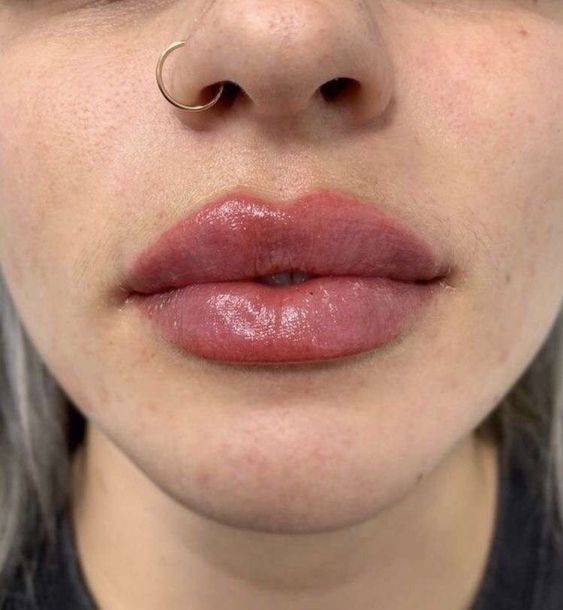 side effects of lip injections