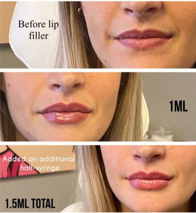 1 ml lip shape lip fillers