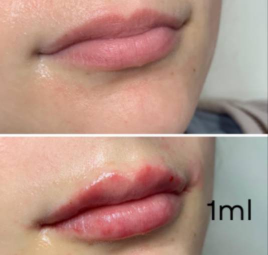 1 ml lip shape lip fillers