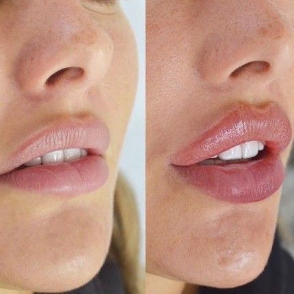 types of lip fillers brands