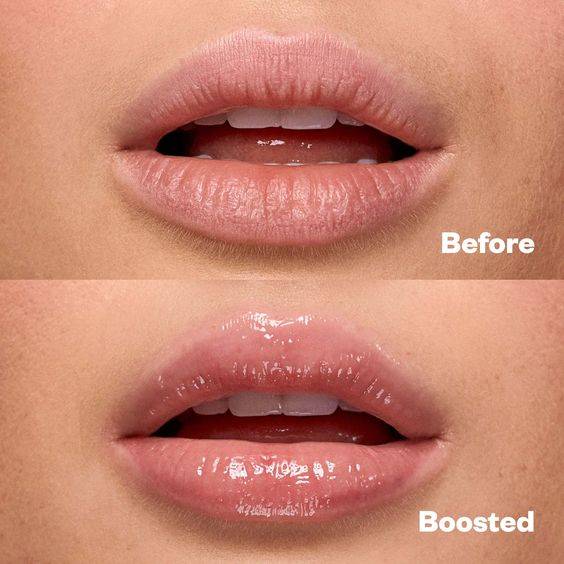 types of lip fillers brands