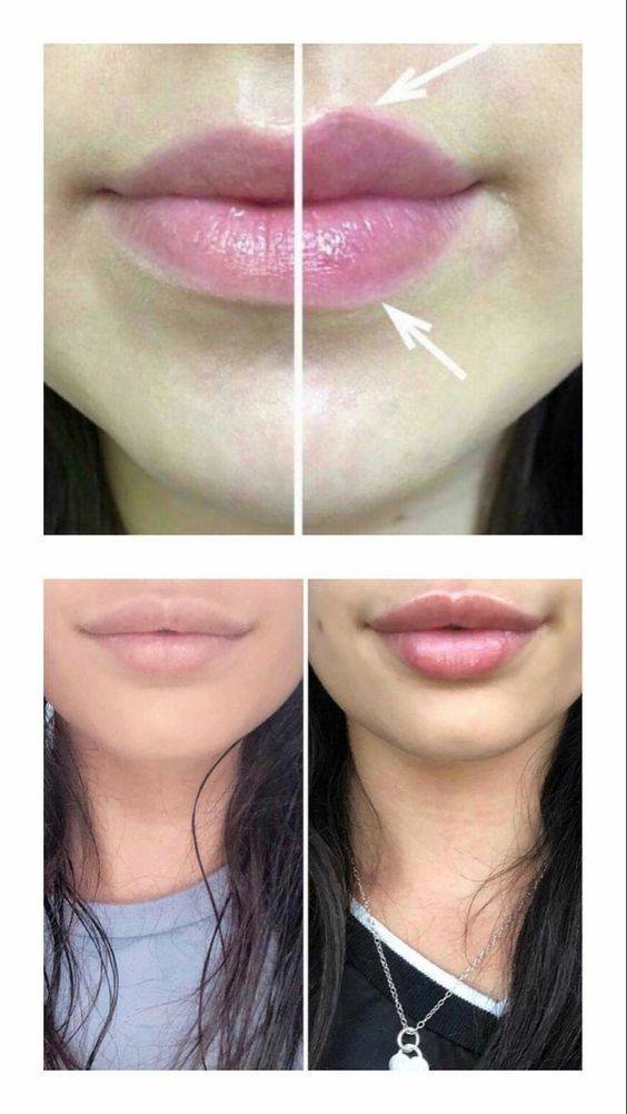 types of lip fillers brands