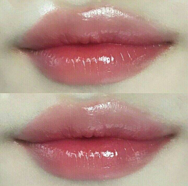 types of lip fillers brands