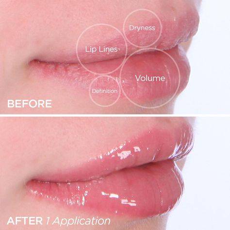 collagen lip injections