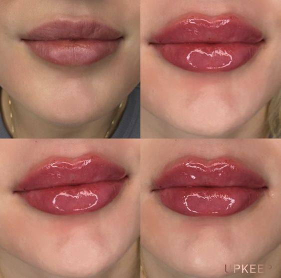  what to Put on Lips After Filler