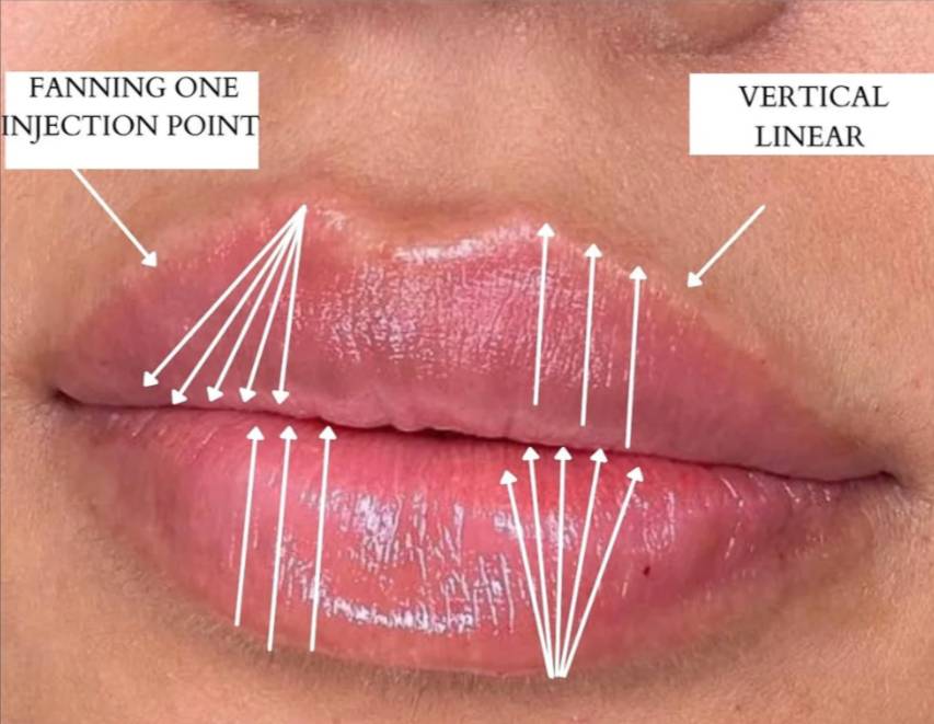 where not to inject lip filler