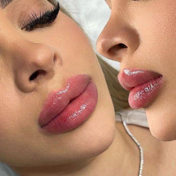 lip filler injection points