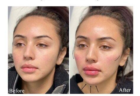 Fillers for sunken cheeks before and after