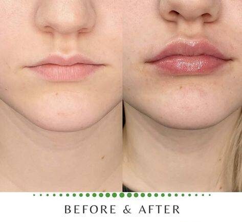 2ml Lip Filler Before and After Thin Lips