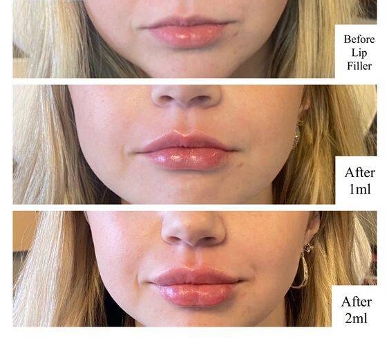 2ml Lip Filler Before and After Thin Lips