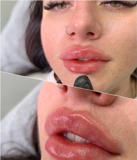 2ml Lip Filler Before and After Thin Lips