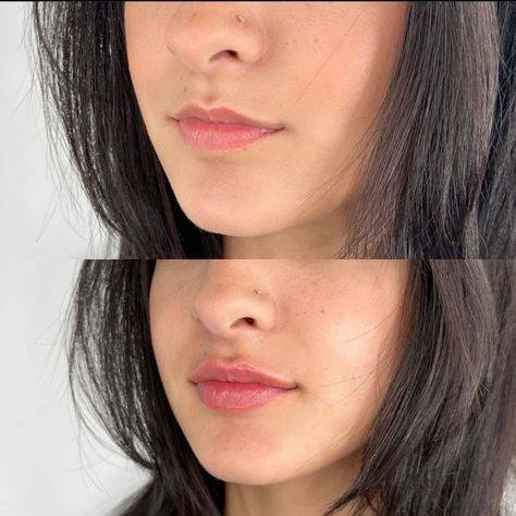 2ml Lip Filler Before and After Thin Lips