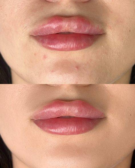 2ml Lip Filler Before and After Thin Lips