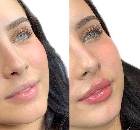 2ml Lip Filler Before and After Thin Lips