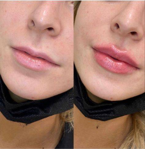 2ml Lip Filler Before and After Thin Lips