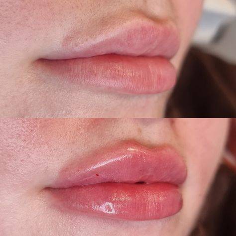 5 lip filler before and after