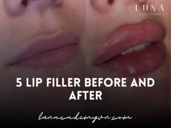 5 lip filler before and after