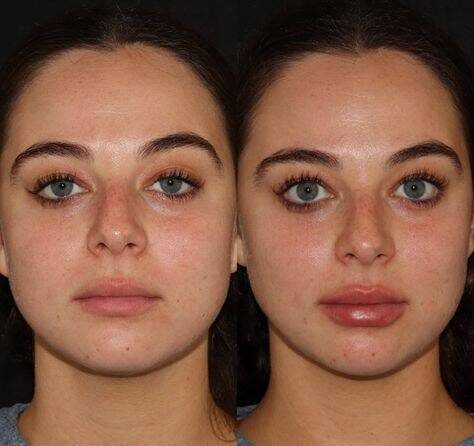 5 lip filler before and after