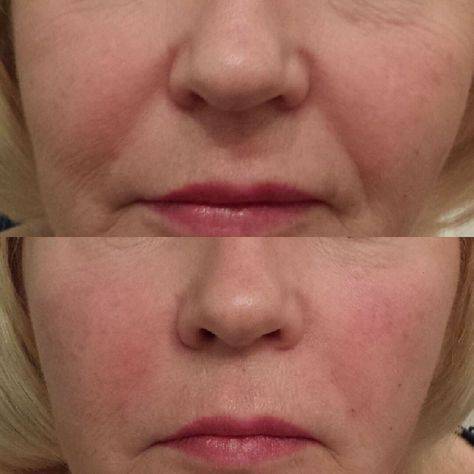 Fillers for sunken cheeks before and after