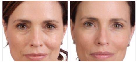 Fillers for sunken cheeks before and after