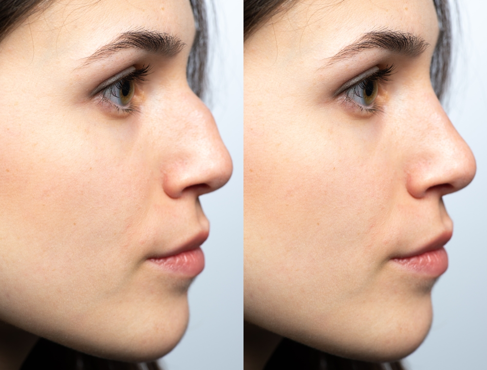 Benefits of Nose Filler Injections: