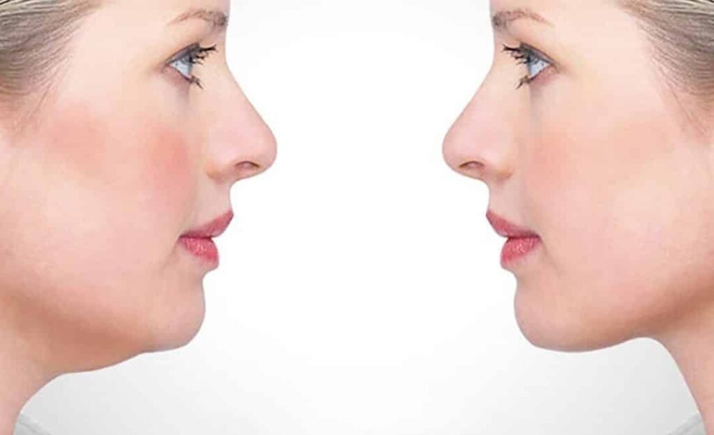 Mesotherapy Chin