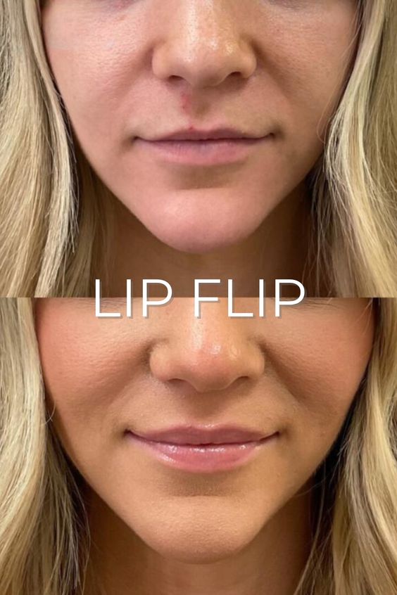 Types of Lip Filler Courses