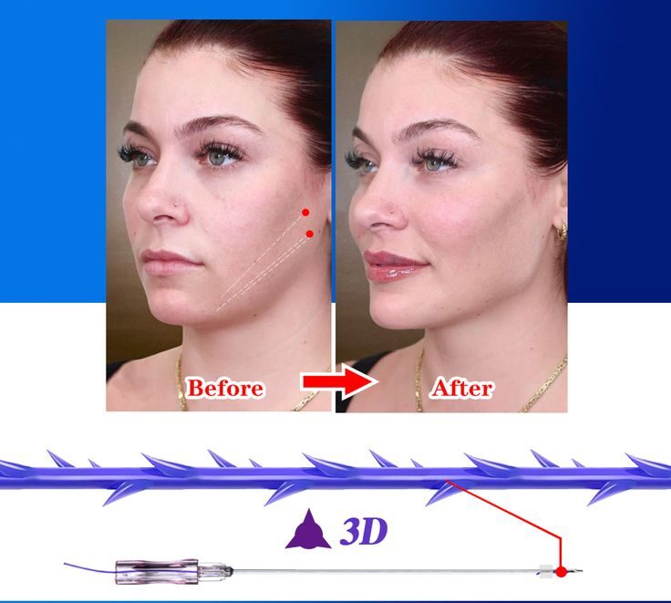 A chin thread lift 