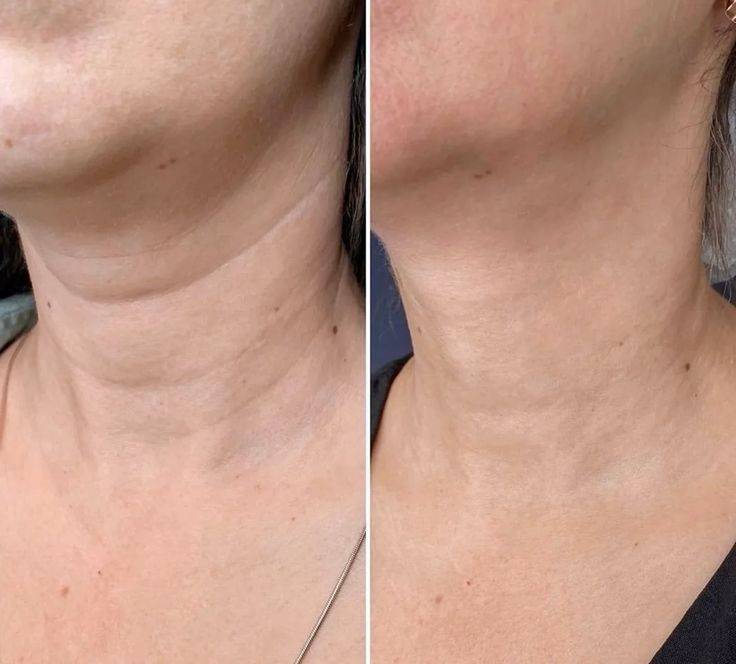 Aging neck 