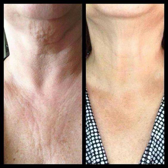 Aging neck 