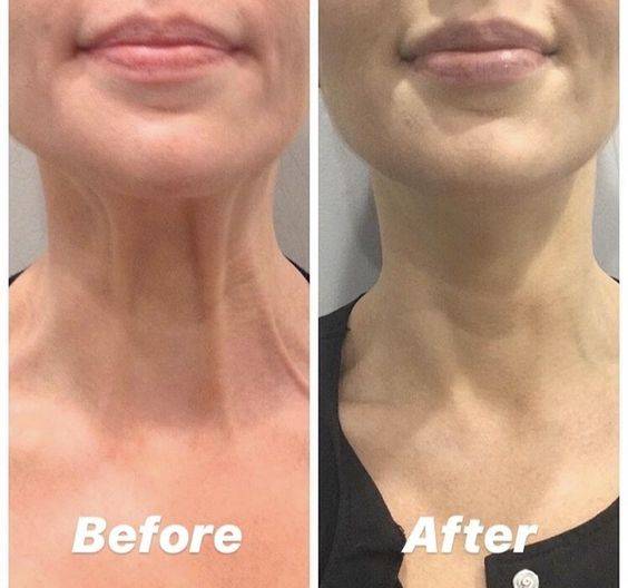 Aging neck 