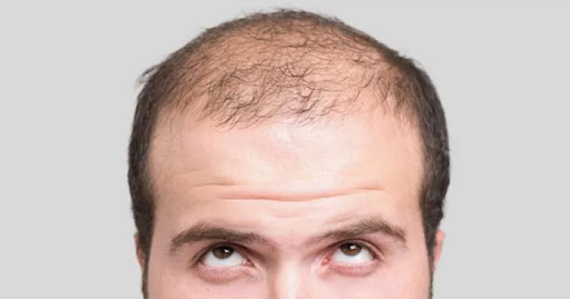 Alternatives to Mesotherapy for Hair Loss