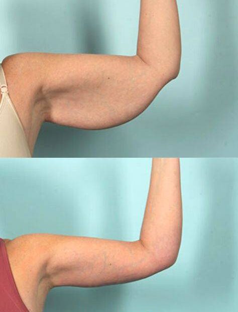 arm fat injections