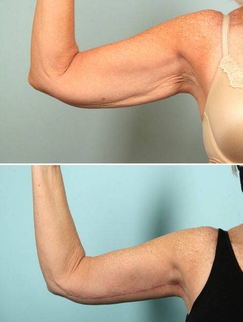 arm fat injections