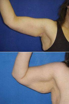 arm fat injections