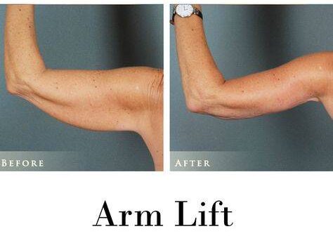 arm fat injections